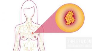 Adenosi delle ghiandole mammarie: una descrizione della patologia, che cos'è dal punto di vista della medicina moderna